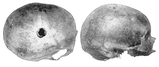 Trepanned Tarahumare Skull, Female.